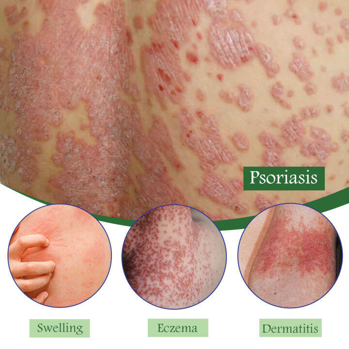 20g Psoriasis Relief Cream Effective Folliculitis Treatment Stops