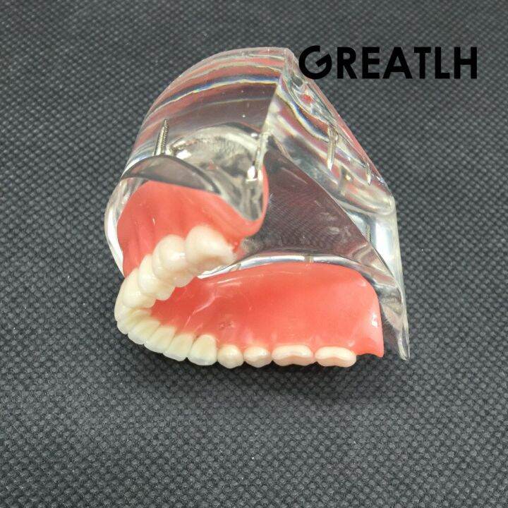 dental-overdenture-interior-mandibular-lower-teeth-model-mandibular-with-implant-restoration-tooth-dental-teaching-study