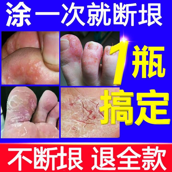 【buy 2 Hong Kong Feet A Touch Of Spirit Foot Smelly Feet Sweaty Toe Seam Rotten Feet Peeling