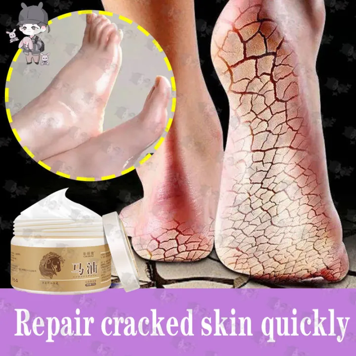 ⚡FLASH SALE⚡COD cracked heel remover hand cream for dry hands foot