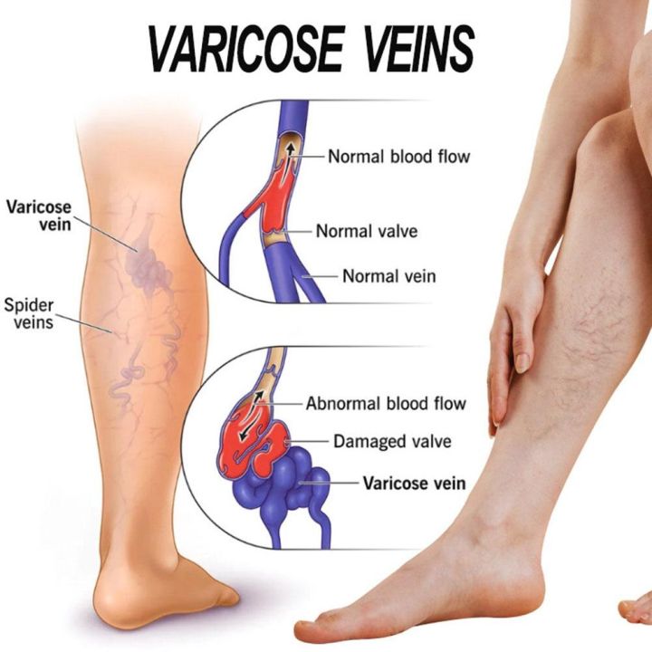1ชิ้นครีม20กรัมสำหรับเส้นเลือดขอดที่เท้า-s-ครีม-relief-เส้นเลือดขอดที่เท้าที่มีประสิทธิภาพเพื่อบรรเทาการรักษาอาการปวดแมงมุม-vasculitis-phlebitis