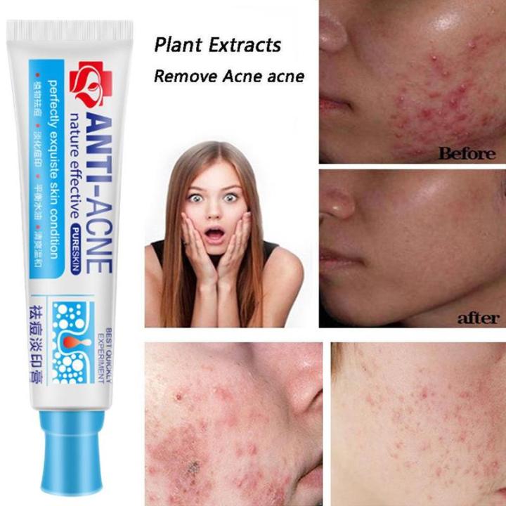 uclanka-traditional-chinese-medicine-acne-shrinking-pore-whitening-gel-whitening-moisturizing-acne