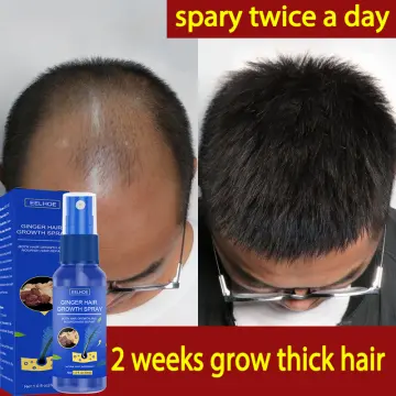 Mua 5% Minoxidil for Men & Women 180ml, Minoxidil Hair Growth Spray Biotin Hair  Regrowth Treatment Serum for Stronger Thicker, Stop Thinning and Hair Loss  Hair Loss Treatmen 3 Month Supply trên
