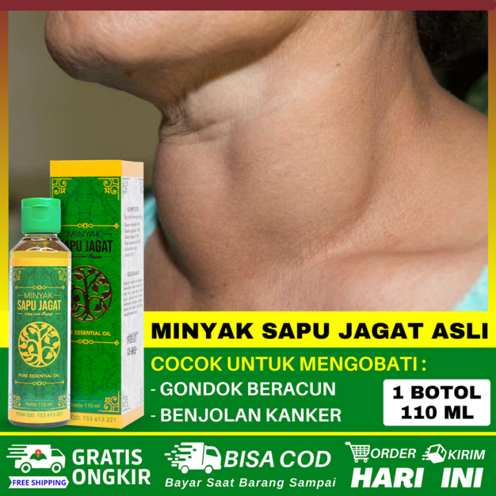 Obat Oles Gondok Dalam Leher Gondongan Gondokan Beracun Benjolan Di ...