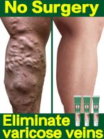 ครีมสำหรับเส้นเลือดขอดที่เท้า S มีประสิทธิภาพเส้นเลือดขอดที่เท้าครีม Relief เพื่อบรรเทาการรักษาอาการปวดแมงมุม Vasculitis Phlebitis