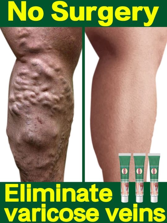 ครีมสำหรับเส้นเลือดขอดที่เท้า-s-มีประสิทธิภาพเส้นเลือดขอดที่เท้าครีม-relief-เพื่อบรรเทาการรักษาอาการปวดแมงมุม-vasculitis-phlebitis