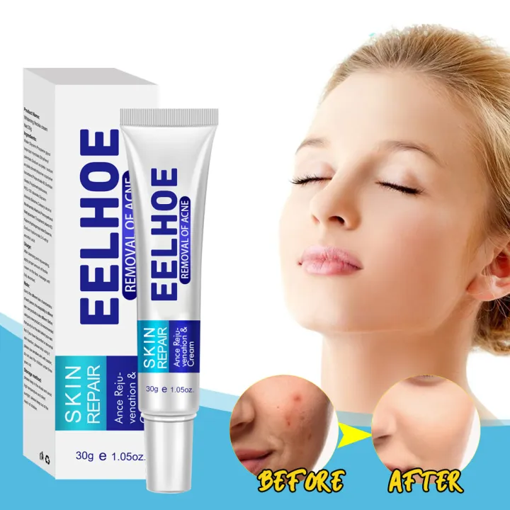 Eelhoe Effective Acne Removal Cream Herbal Anti Acne Treatment Fade