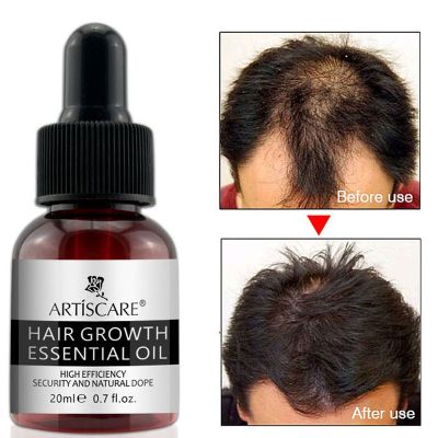 【cw】 Ginger Hair Growth Essential Oils Anti Hair Loss Serum Anti Hair Loss Product Germinal Repair Growing Treatment Liquid Men Women ！