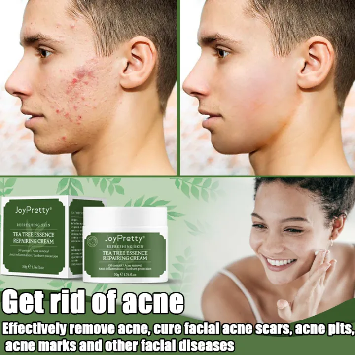 Pure Herbal Essence JOY PRETTY Acne Treatment Ointment Acne Repair Gel