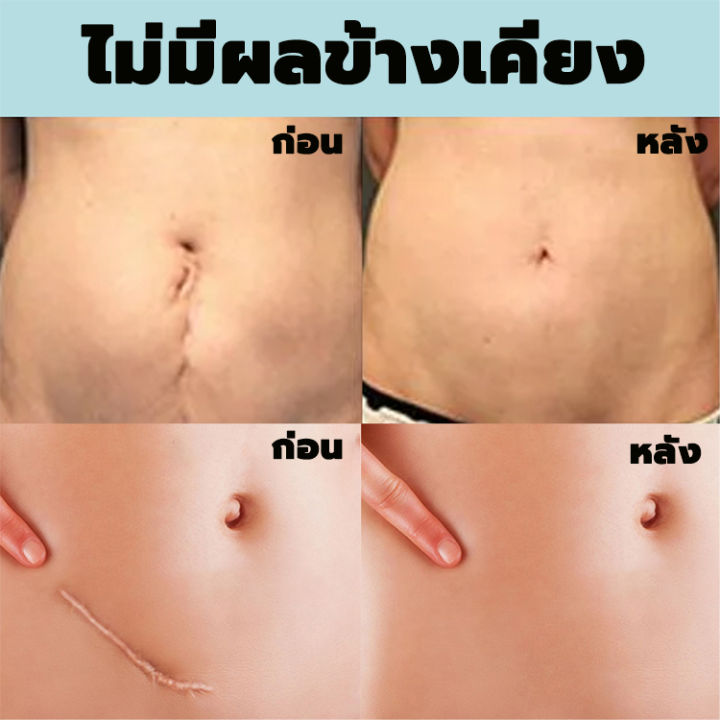 ฟื้นฟูผิวให้แข็งแรง-ครีมลดรอยแผล-50g-ยาทาแผลเป็น-ยาทาแผลเป็นนูน-ครีมลบรอยแผลเป็น-ลบรอยแผลเป็น-ครีมทาแผลเป็น-แผลไฟไหม้-คีลอยด์-ซ่อมแซมผิวที่เสียหาย-ครีมซ่อมแซม-แผลผ่าตัด-scar-cream