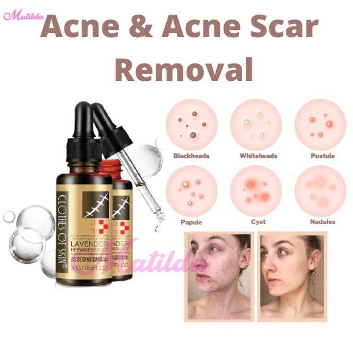 Lavender Repair Essence From Clothes of Skin 30g Acne Pimple Marks