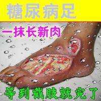 Foot old rotten legs to putrefaction muscle cream foot black festering wound suppuration promoting long meat healing