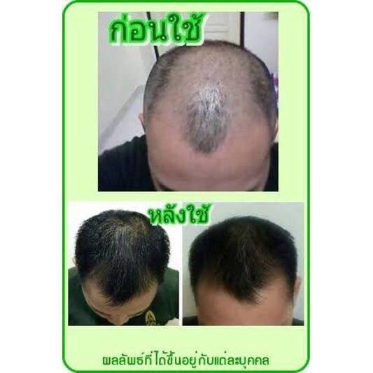 นีโอแฮร์โลชั่น-neo-hair-lotion-แบรนด์แท้-ส่งด่วน-1-ขวด-บรรจุ-120-ml-สเปรย์ปลูกผม-เซรั่มปลูกผม-ปลูกผม-ลดผมร่วง-น้ำยาปลูกผมหนา-น้ำยาปลูกผม-ปลูกผ