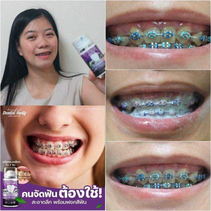 ยาสีฟันฟอกฟันขาว-เจลฟอกฟันขาว-เจลฟอกฟันเดนทัลสวิตซ์-dental-switz-รางฟอกฟัน-1-ชุด-ล่าง-บน-ส่งฟรีไม่ใช้โค๊ด