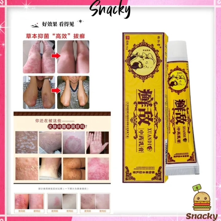 ready stock 【1010 PROMO】XUANDI Psoriasis Cream Eczema Cream Ezcema