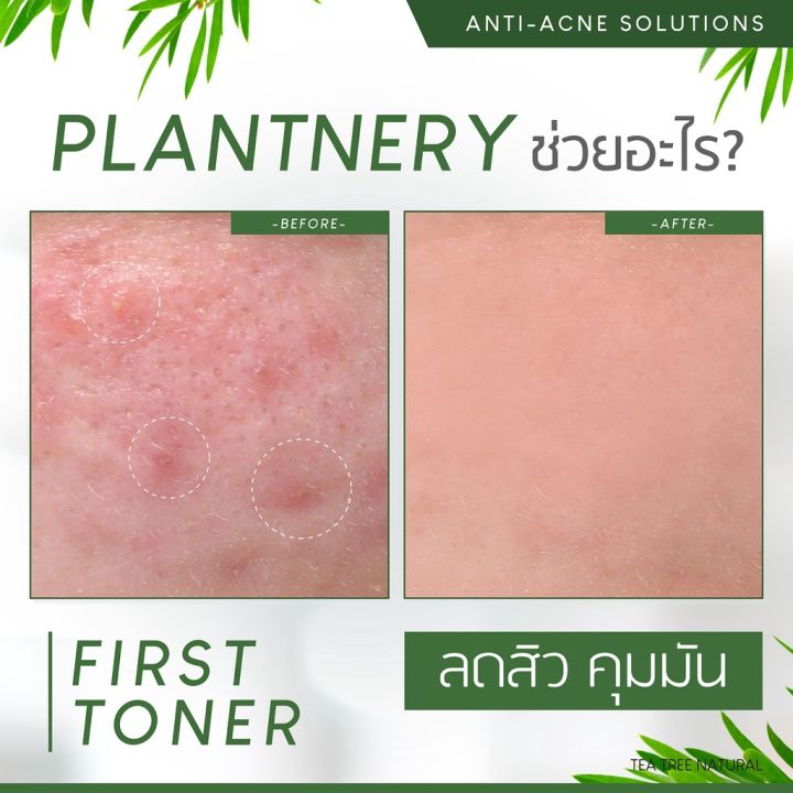 plantnery-tea-tree-first-toner-250-ml-โทนเนอร์-ที-ทรี-สูตรช่วยลดสิว-และควบคุมความมัน-รู้สึกรูขุมขนกระชับ-บอกลาปัญหาสิว