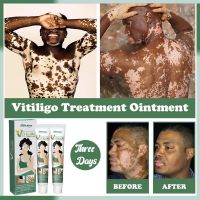 【CC】 20g Herbal Extract Vitiligo Ointment Remove Ringworm Removal Leukoplakia Disease Treatment