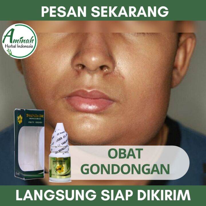 Obat Herbal Gondongan Obat Alami Gondongan di Leher Obat Leher