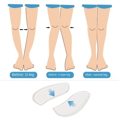 2 Pcs Silicone Insoles Orthotics X/O-type Legs Corrector Gel Pillow For Heel Orthopedic Insoles Shoes Pad For Feet Care Solid