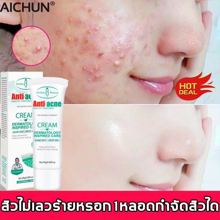 สิวไม่เลวร้ายหรอก 1หลอดกําจัดสิวได้！Aichun ครีมทาสิวฮอโมน 20G แก้ปัญหาผิวจากพื้นฐาน  ซ่อมแซมรอยสิว ผิวใสบริ๊งค์ ผิวเรียบเนียน ไปสิวหัวดำ ป้องกันสิว ครีมทาหลุมสิว  ลบรอยสิว ครีมกำจัดสิว ครีมทาสิวอักเสบ เซรั่มลดสิว ครีมแต้มสิว กำจัดสีว |  Lazada.Co.Th