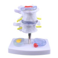 Lumbar amplification of lumbar compression demonstration model of human spine vertebra pathological joints medicine use