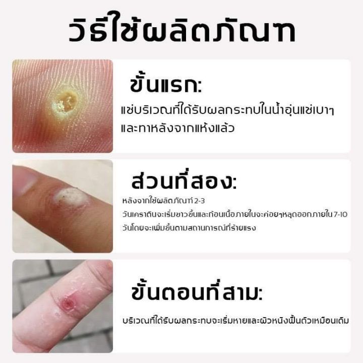 ส่งฟรี-sumifun-ครีมทาผิวทรีทเม้นท์-ทาหูด-20-กรัม