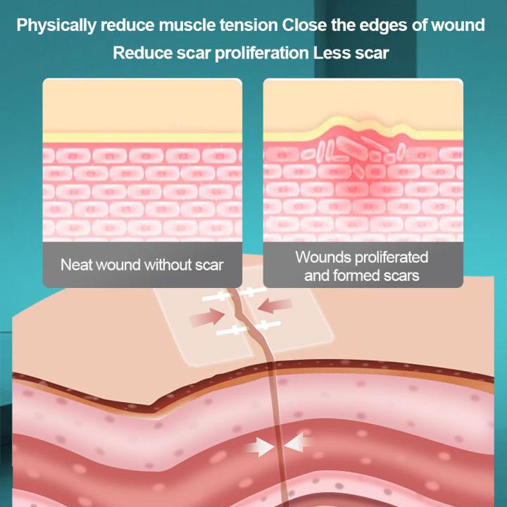 cofoe-อุปกรณ์ช่วยปิดแผลแบบไม่ทำให้แผลไม่เจ็บโดยไม่ต้องใช้เข็มเย็บแผลแพทช์เย็บแผลแบบซิปช่วยลดสายรัด