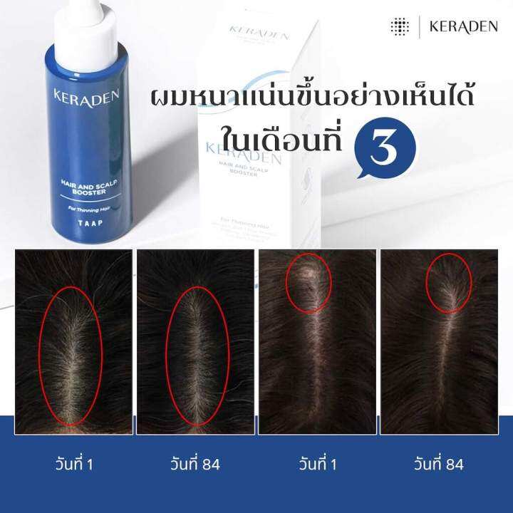 keraden-serum-เคราเดน-เซรั่ม-บำรุงผม-ให้แข็งแรง-ไม่หลุดร่วง-เพิ่มผมงอกใหม่-ขนาด-30-มล-จำนวน-1-ขวด