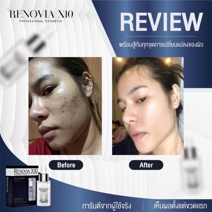 ตรงปก-จบปัญหาผิวหน้า-ของแท้-renovia-x10เซรั่มหน้าใส-ลดฝ้ากระจุดด่างดำ-ฺั-by-18-อีกครั้ง