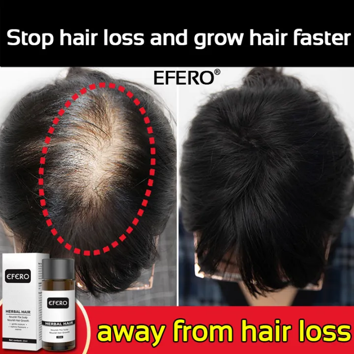 EFERO hair Growth Essence Serum,contains ginseng&ginger extracts to help hair regrow(Hair tonic Hair Regrowth EFERO hair Growth Essence Serum,contains ginseng&ginger extracts to help hair regrow(Hair tonic Hair Regrowth