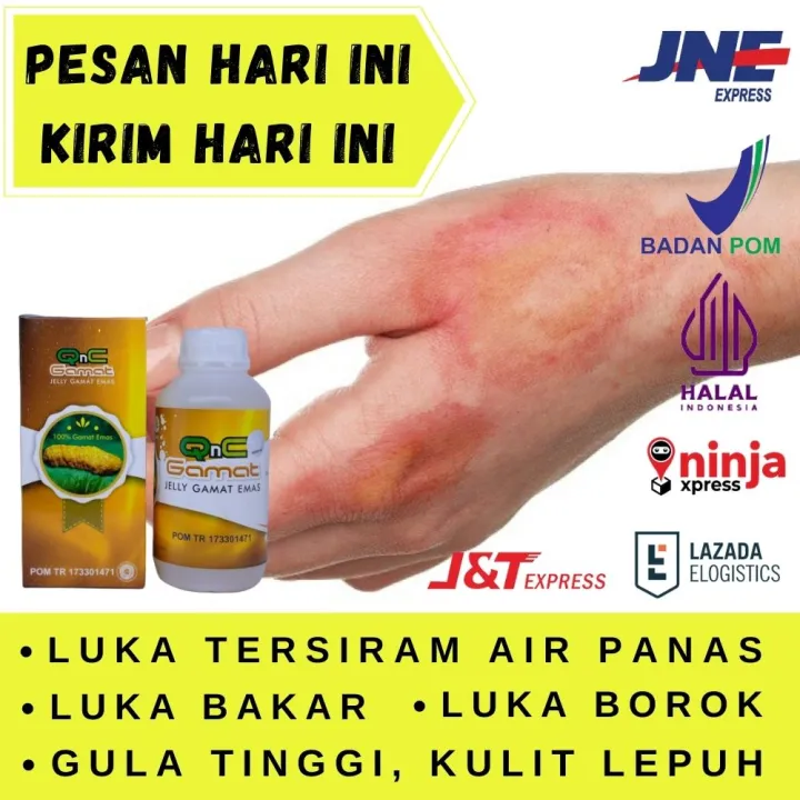 Obat Luka Tersiram Air Panas Bakar Borok Ringan Parah Herbal Gatal Kulit Melepuh Di Wajah Tangan