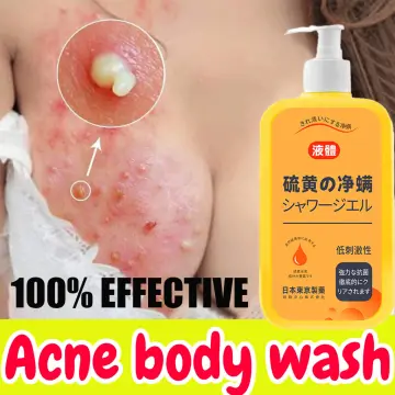 Sulfur Soap Mite Remover Soap Anti Fungal Scabies Acne Treatment Body  Lightening