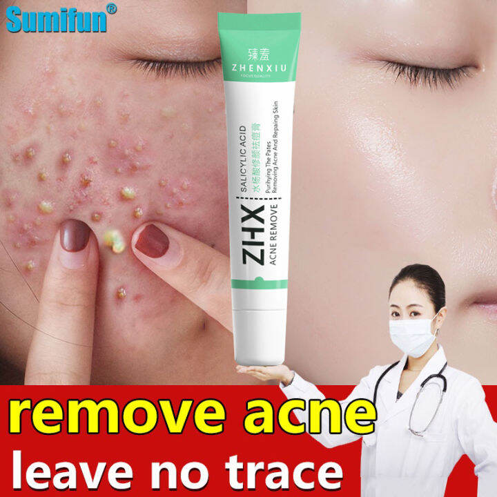Acne Treatment cream salicylic acid Scar Treatment Serum Pimple Scar