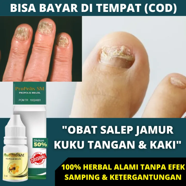 Obat Tetes Kuku Rusak Berjamur Jamur Cantengan Kaki Rusak Hitam Kuning