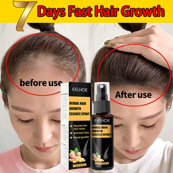 Hair Grower Spray For Men Original Minoxidil Hair Growth 10 x Faster ...