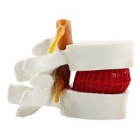 Human Body Model Intervertebral Disc Anatomical Lumbar Herniation Spine 11.3X7.6Cm Learning White Pvc Teaching Demonstrating