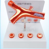 Blood level of artery-clogging fat pathological blood vascular atherosclerosis human vascular anatomic model