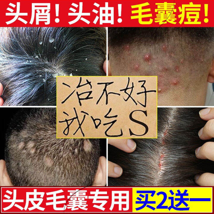 Folliculitis Can Be Matched with Scalp Dandruff Head Ringworm Seborrhea