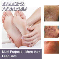 Psoriasis Skin สะเก็ดเงิน ลดรอยแดง ผิวเรียบเนียน ปลอดภัย ลบการติดเชื้อ 2 ชิ้นสำหรับใช้ประจำวันสำหรับมือ