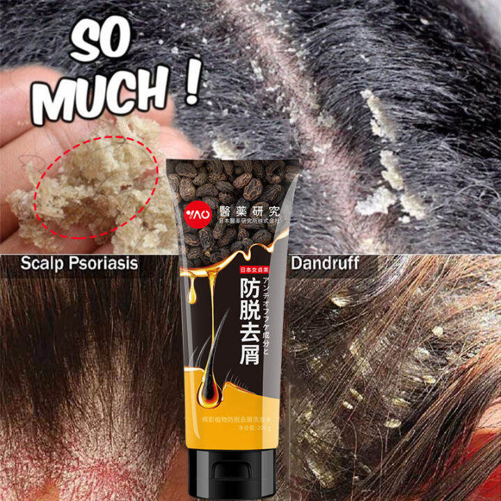 🔥🔥japan Hot🔥🔥anti Dandruff Shampoo For Treating Itching Peeling Scalp