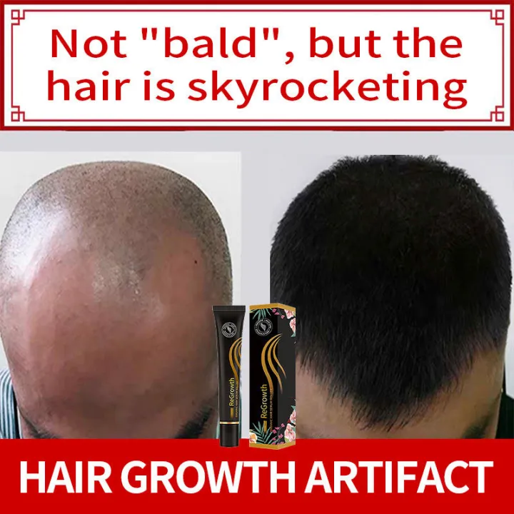 Hot 】hair grower fast long hair Men Women Hair Growth Hair Care 100 Pure Natural Treatment Hot 】hair grower fast long hair Men Women Hair Growth Hair Care 100 Pure Natural Treatment