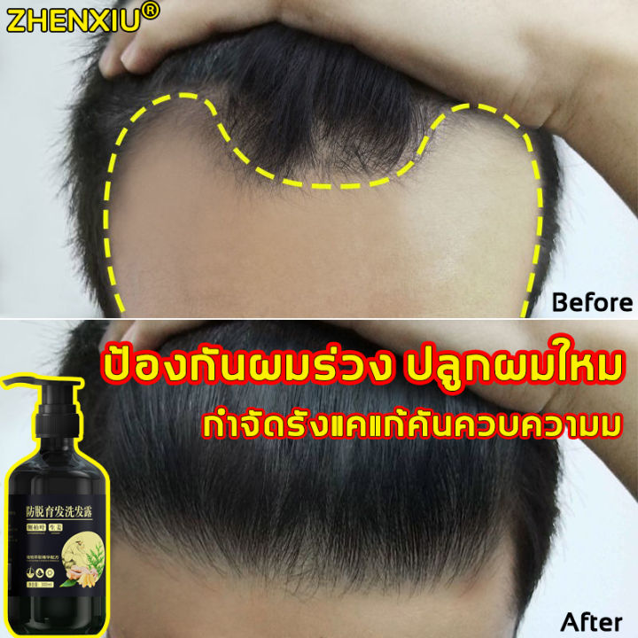 zhenxiu-แชมพูขิง-300ml-แชมพูแก้ผมร่วง-แชมพูขิงของแท้-แชมพูลดผมร่วง-แชมพูเร่งผมยาว-แชมพูปลูกผมดก-แชมพูขจัดรังแค-ยาสระผม-แชมพูสระผม-ยาสระผมแก้ร่วง-ยาสระผมเร่งยาว-แชมพูขิงเพียว-shampoo