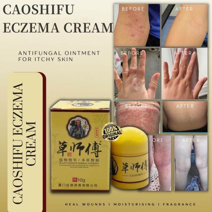 ♡caoshifu Psoriasis Eczema Cream For Skin Problems Patch Body Massage Ointment Chinese Herbal 7756