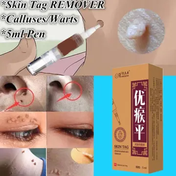 Skin Tag Remover Pen - Best Price in Singapore - Oct 2023