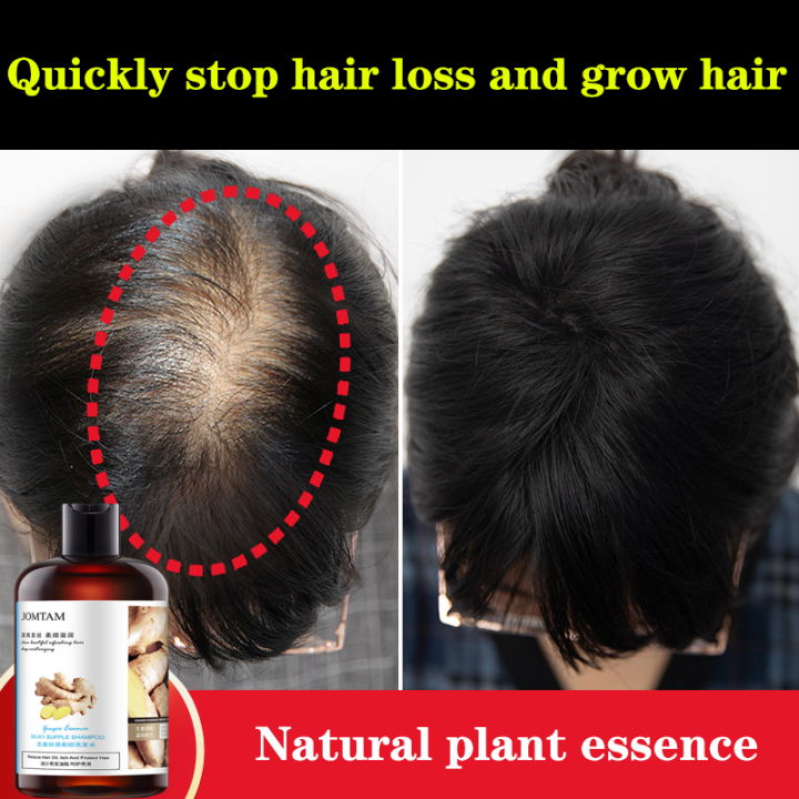 Shampoo to prevent hair loss hair increase dense hair liquid for men and women anti-dandruff anti-itch oil control genuine ginger hair growth 400ml | Lazada Shampoo to prevent hair loss hair increase dense hair liquid for men and women anti-dandruff anti-itch oil control genuine ginger hair growth 400ml | Lazada