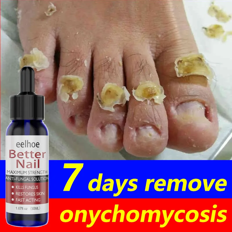 Top more than 138 fungi nail reviews ceg.edu.vn