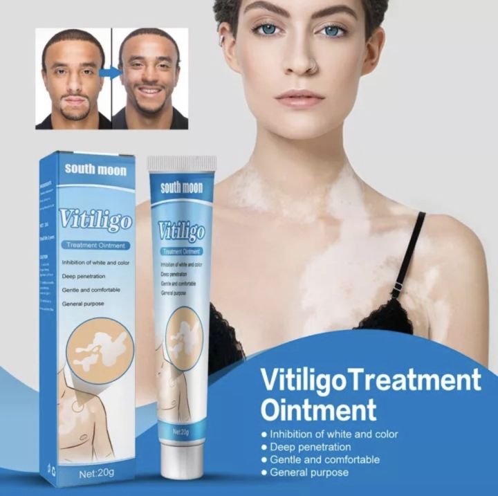 herbal-extract-vitiligo-ส่งทันที-south-moon-ครีมทาด่างขาว-ด่างขาวที่หน้า-ด่างขาวที่หลัง-ด่างขาวที่แขน-ด่างขาวที่ตัว