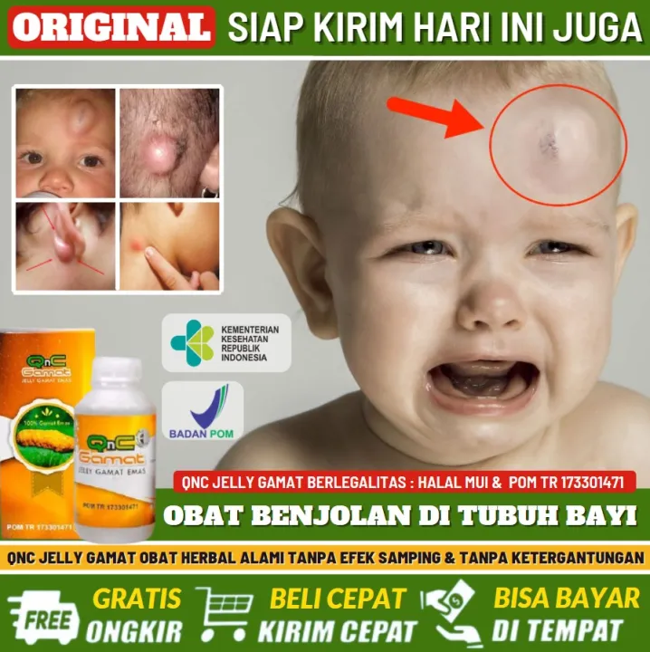 Obat Penyakit Benjolan Pada Bayi 100% Alami, Penghilang Benjolan ...