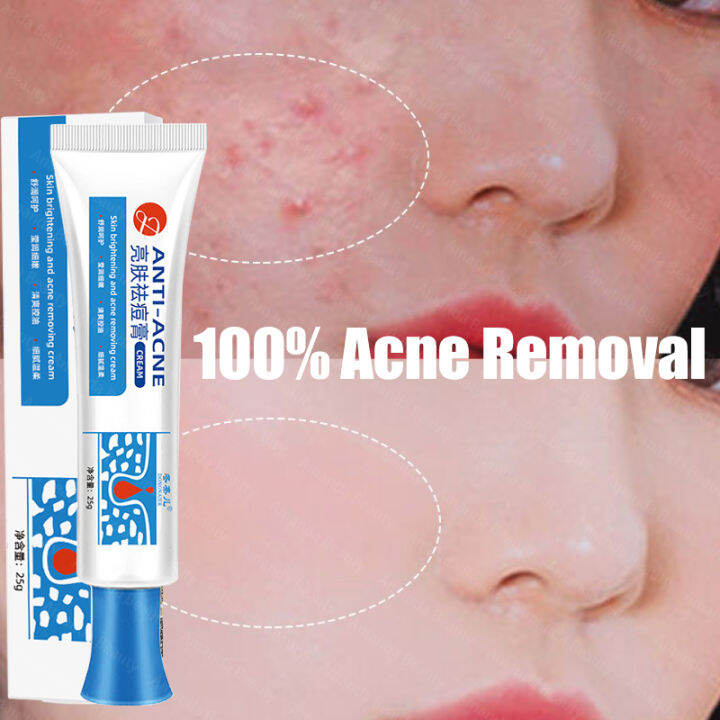 Acne Treatment Gel Acne Cleaning Cream Blackhead Remover Acne Spots Face Scars Skin Care Repair 7398