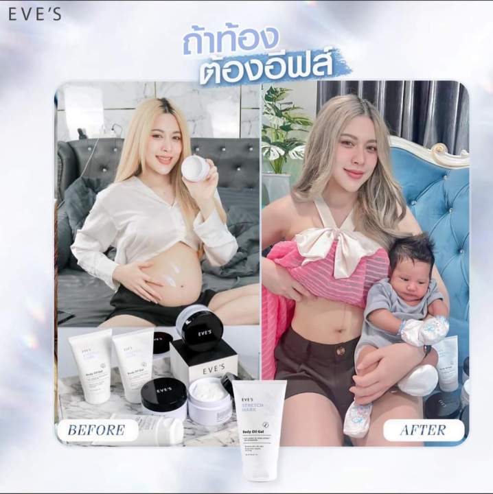 โปร-2-แถม-1-ส่งฟรี-โลชั่นผิวใส-ลดรอยแตกลาย-รอยแผลเป็น-จุดด่างดำ-แตกลายขาว-แตกลายแดง-บูสเตอร์ครีม-อีฟส์ออย-ครีมทาท้อง-คนท้องใช้ได้